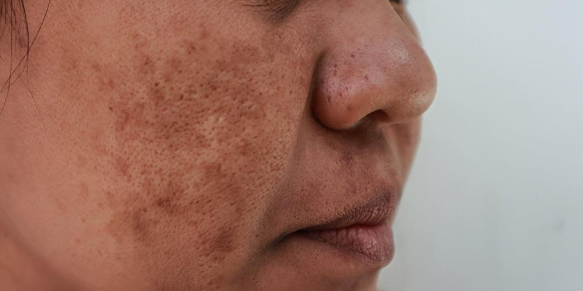Is Your Skin Pigmentation Getting Worse in Islamabad?