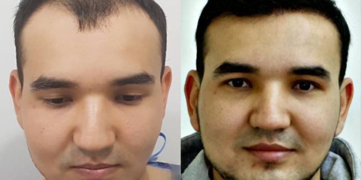 FUE Hair Transplant in Islamabad for Women: Key Considerations