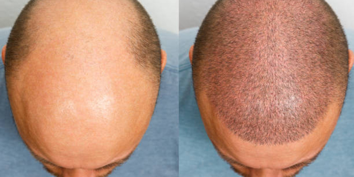 Hair Transplant Preparation Tips for Patients