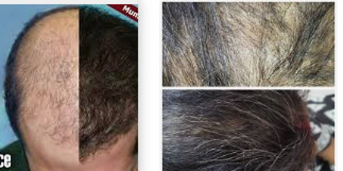 Laser Hair Reduction in Ghatkopar – Smooth, Hair-Free Skin with Expert Care