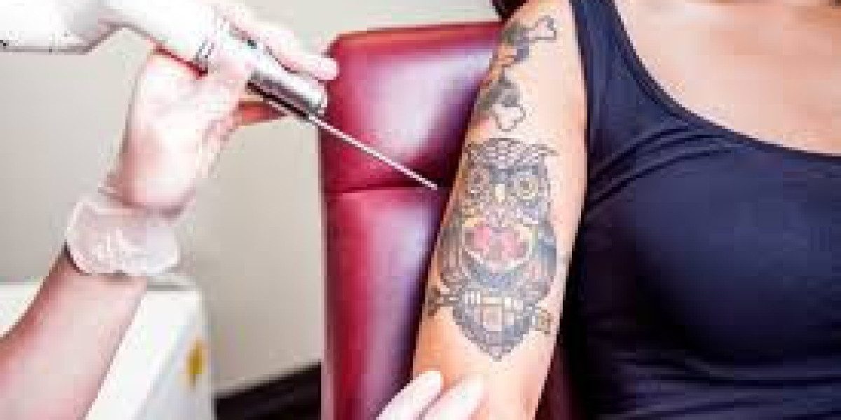 Trusted Centers for Tattoo Removal in Islamabad