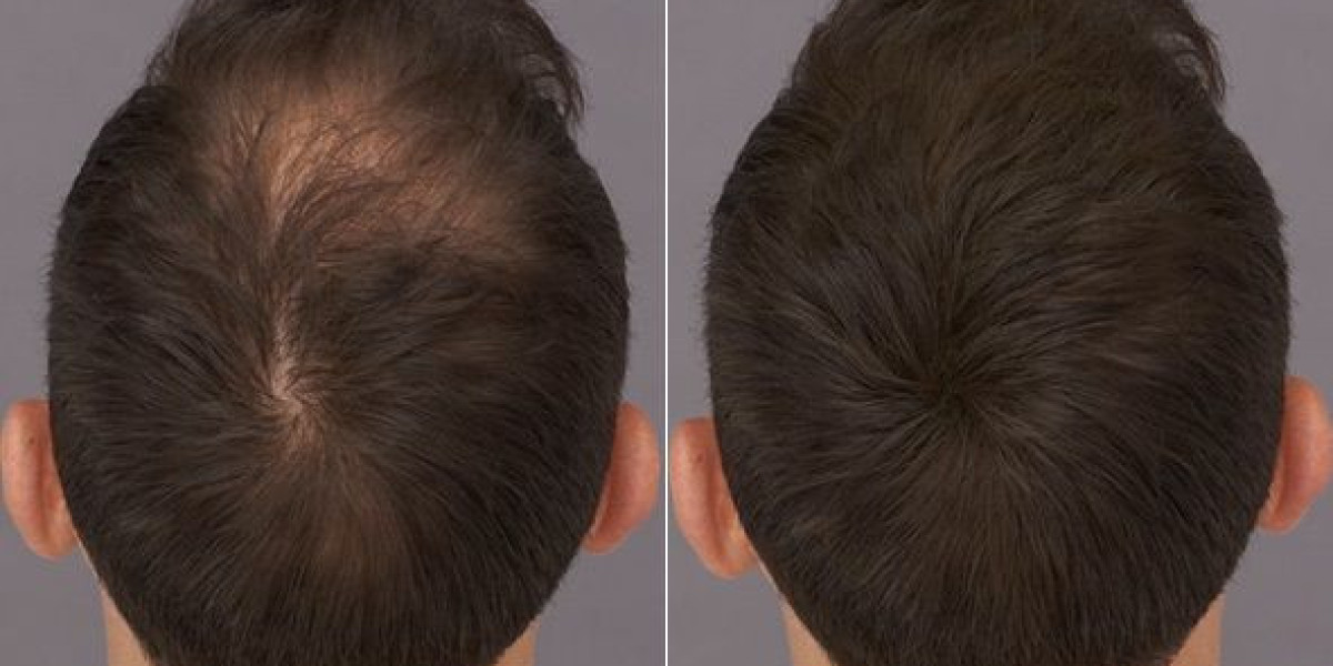 Your Trusted Destination for Hair Transplant at Royal Clinic Saudia