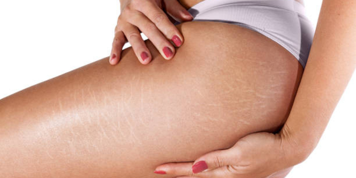 Stretch Mark Removal Solutions for Stubborn Skin Lines