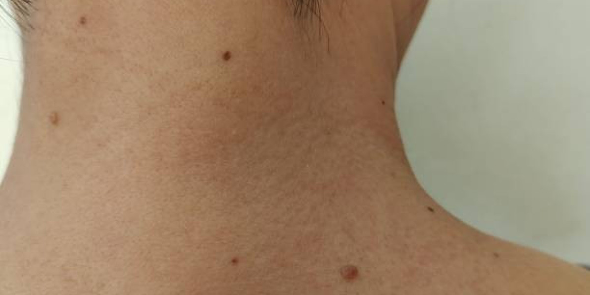 Skin Tag Removal Solutions for Common Skin Concerns