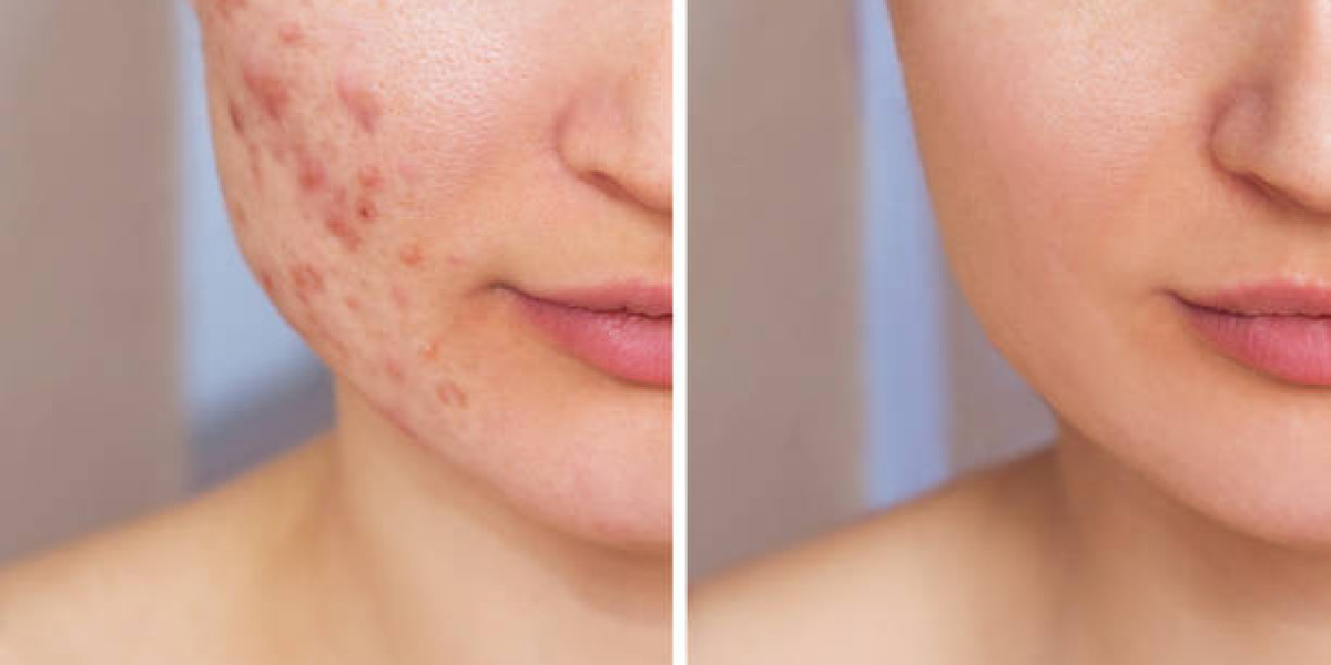 Pimples Treatment Strategies for Ongoing Skin Problems