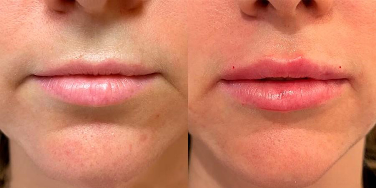 Lip Augmentation in Islamabad: Enhance Your Face