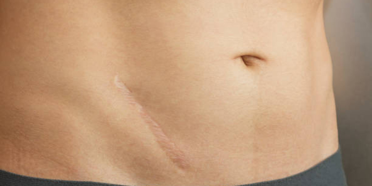Does Laser Scar Removal Blend Hypertrophic?