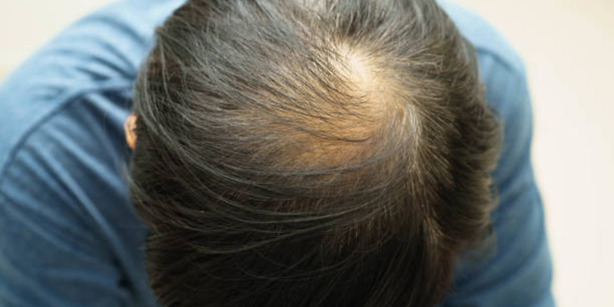 Exosomes Therapy for Hair Loss and Strengthening Hair Roots