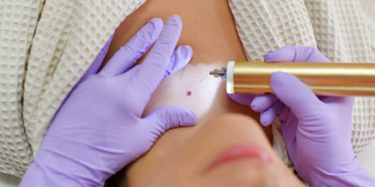 How Frequent Wart Removal Procedure Maintenance?