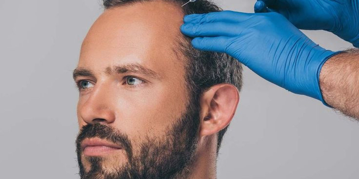 Achieve Fuller Hairlines with PRP Regrowth Therapy