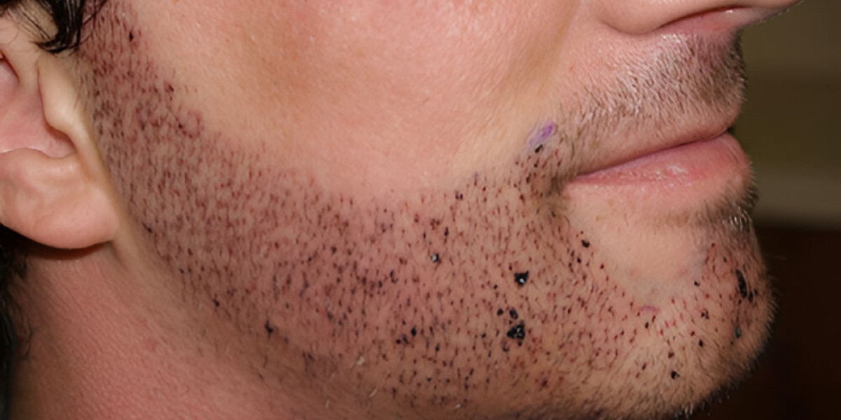 Why Men Prefer Beard Hair Transplant in Islamabad