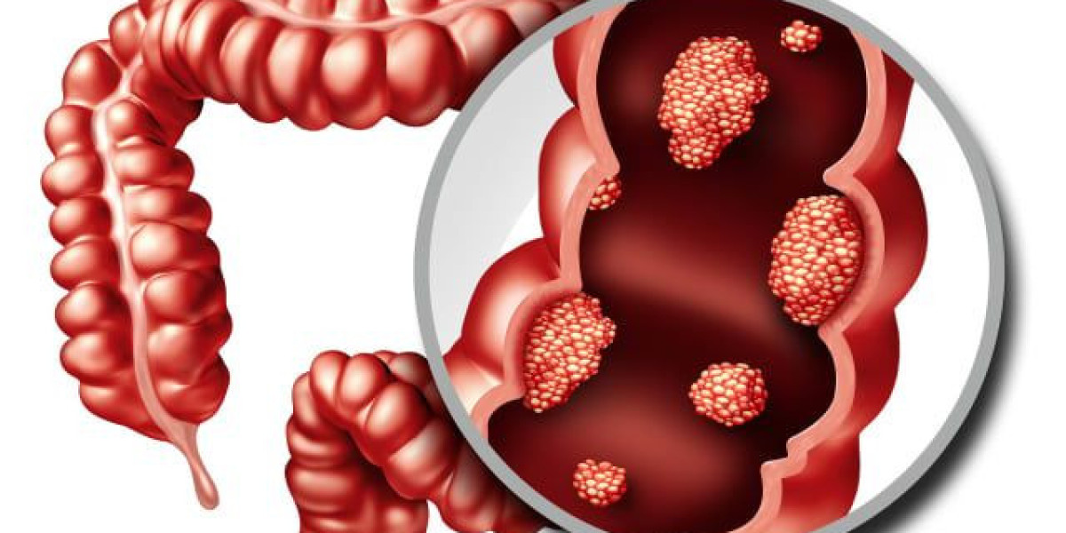 What Is Partial Colectomy? Complete Guide by Dr MSS Keerthi