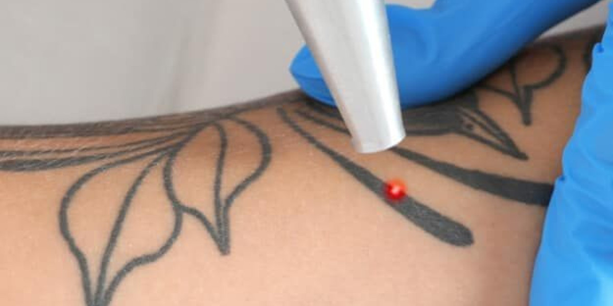 Tattoo Removal Atlanta GA: Process, Technology, and Considerations