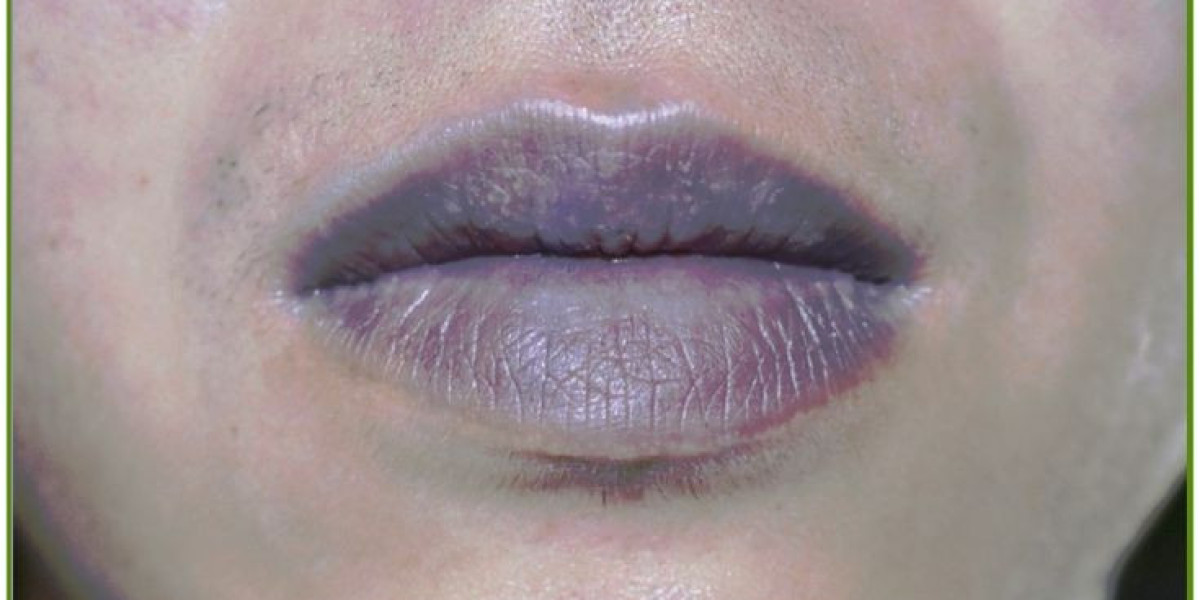 How to Get Noticeably Better Lips with Smoker Lips Treatment