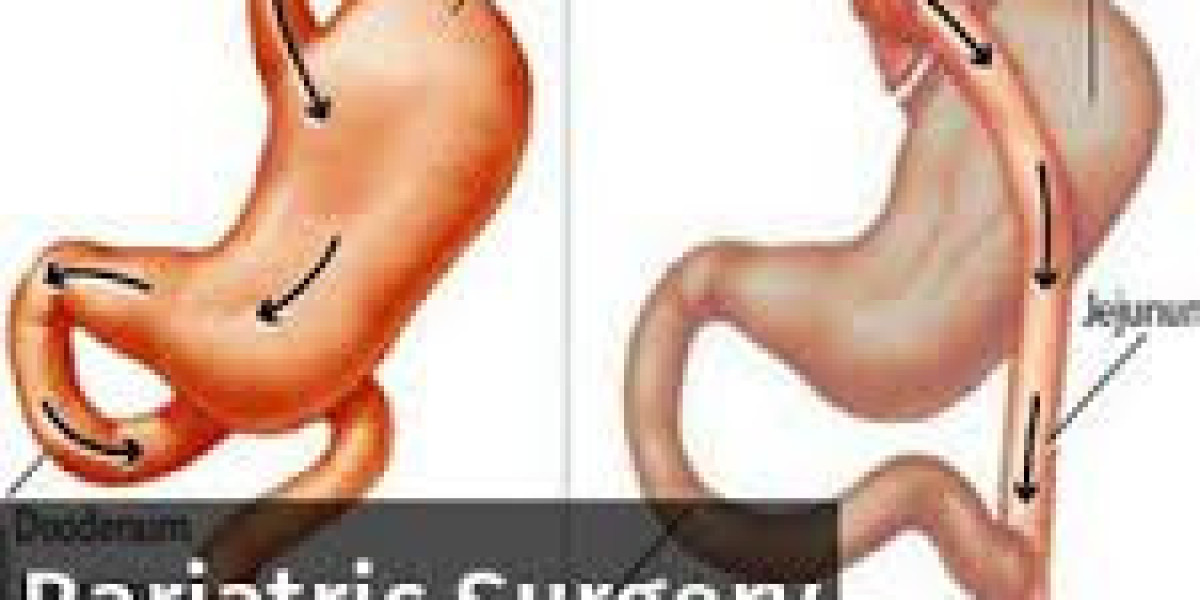 Bariatric Surgery for Positive Results
