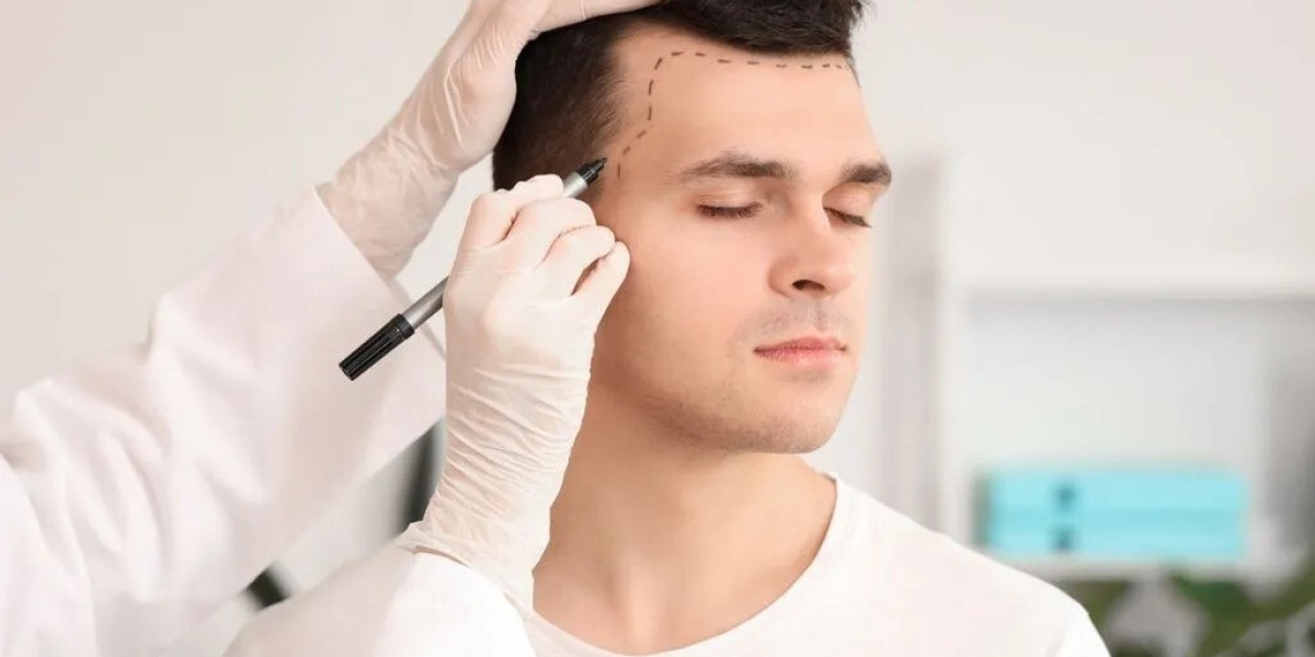 Hair Transplant for Permanent Hair Solution
