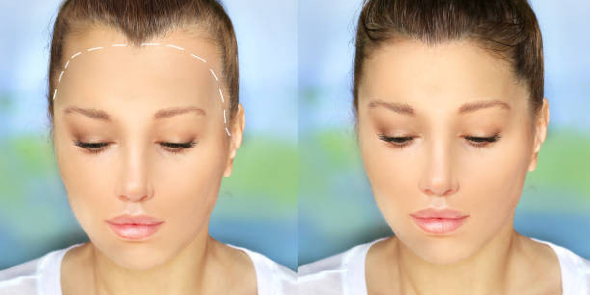What Causes Hair Loss That Leads to Transplants in Riyadh?