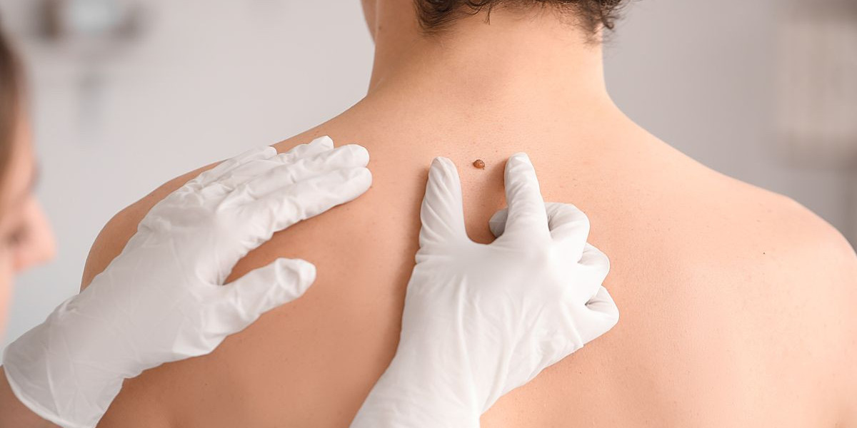 Advanced Skin Technology for Safe Wart Elimination