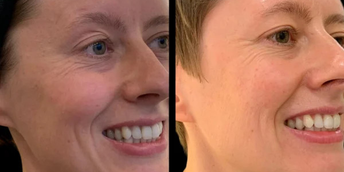 Profhilo in Dubai for Evidence-Based Aesthetic Results