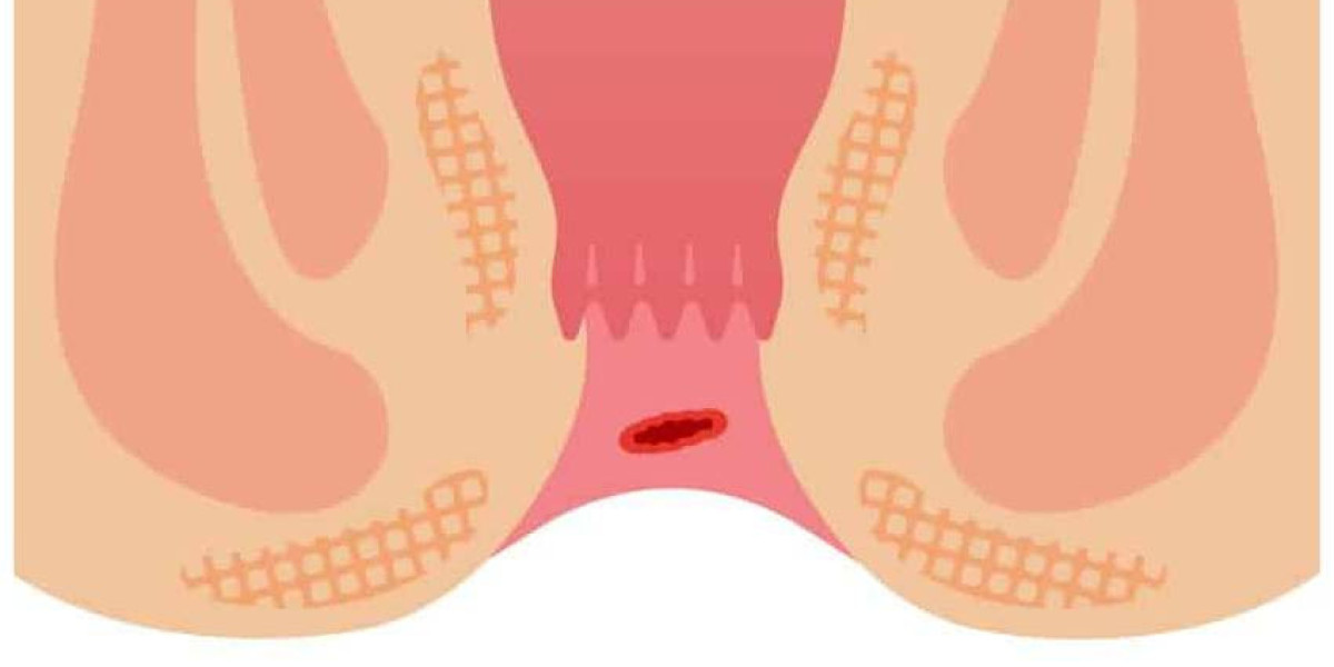 Best Treatment for Piles (Hemorrhoids)