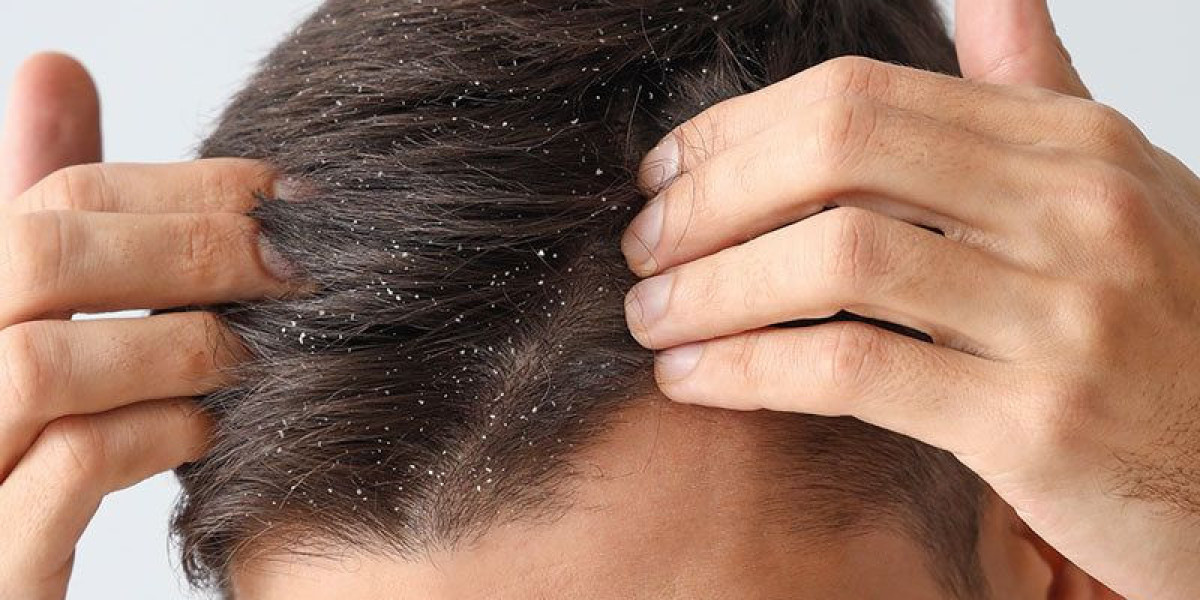 Hair Restoration: Restore Your Hairline with Confidence