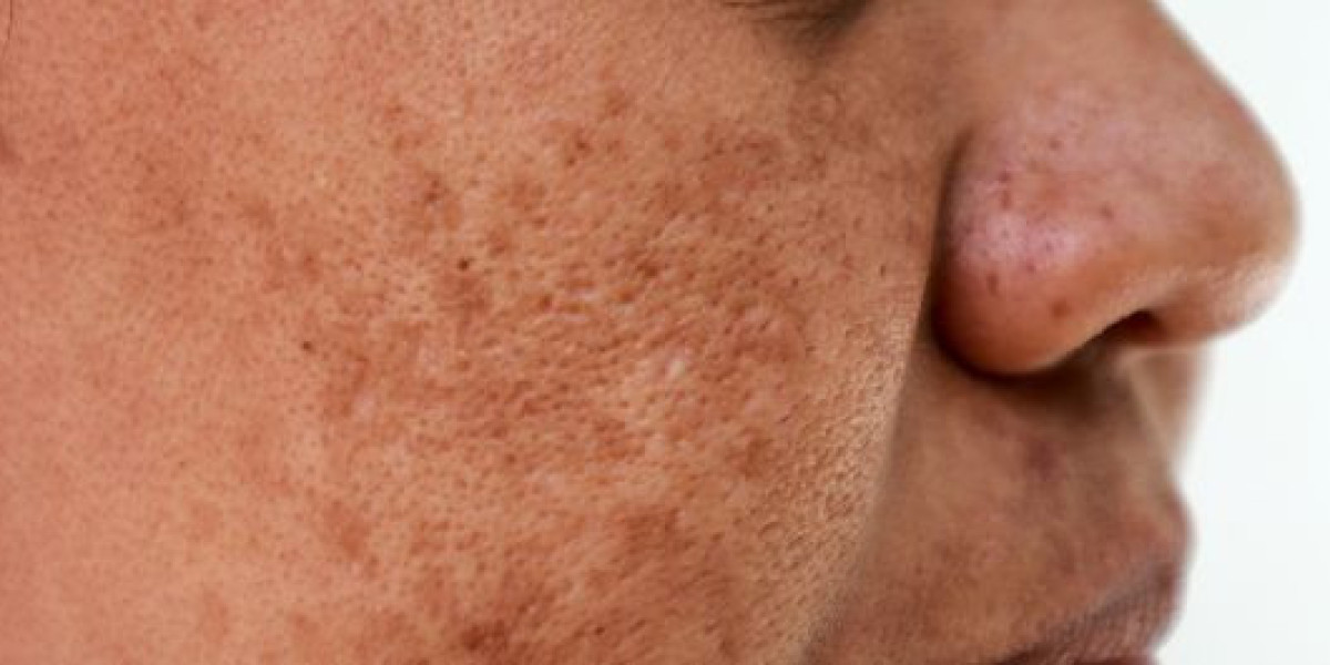 Advanced Laser Care to Reduce Stubborn Birthmarks