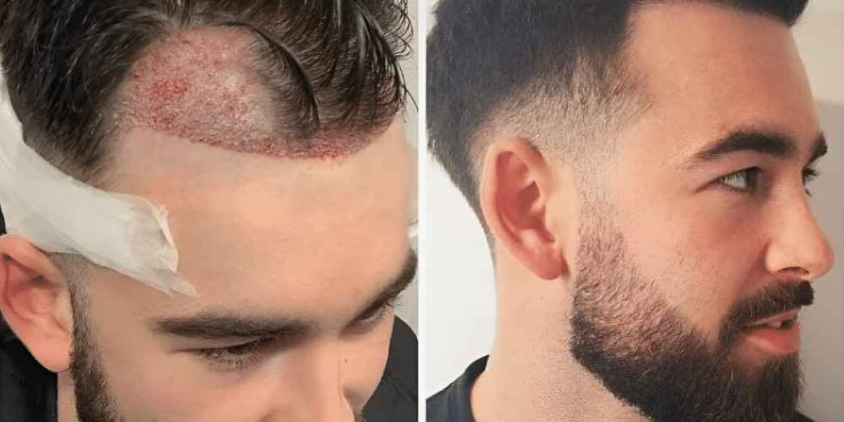 Get Natural Results With Hair Transplant in Islamabad