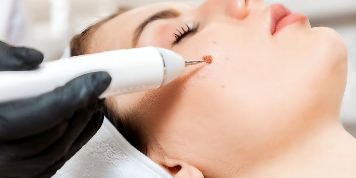 Wart Removal in Islamabad – Quick, Safe & Trusted