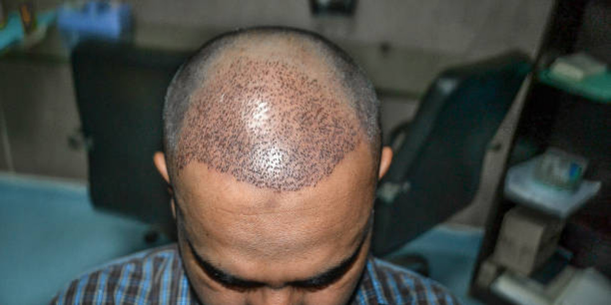 Hair Transplant Donor Areas: Maximizing Supply for Fullness