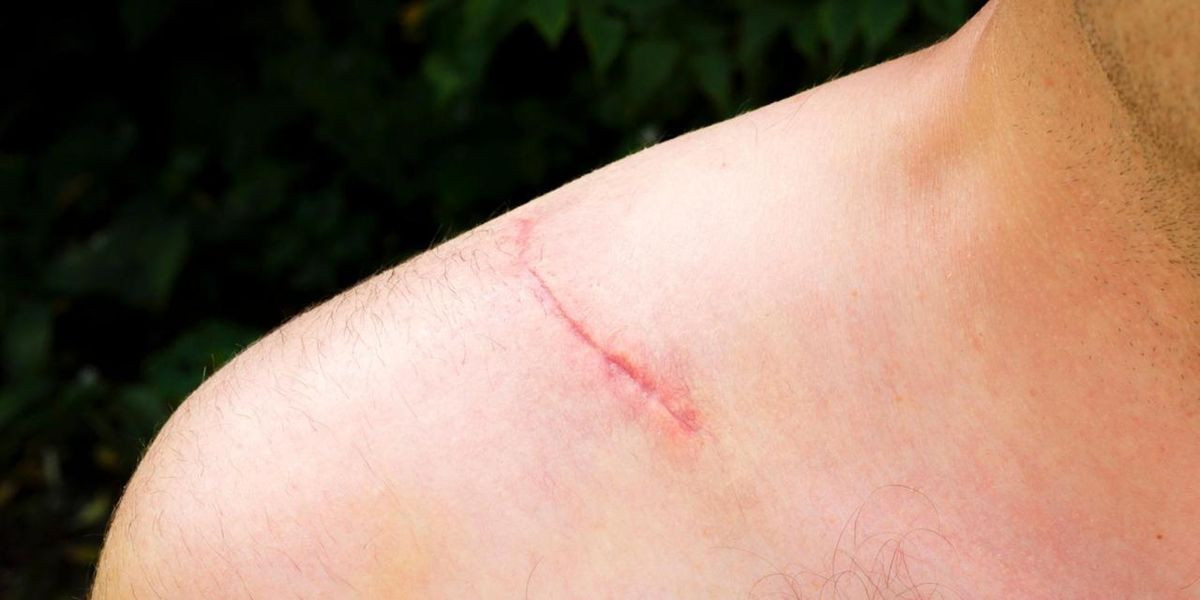 Restore Your Confidence: Stretch Mark Treatments