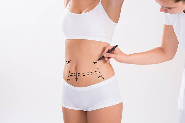 Liposuction procedure in Riyadh