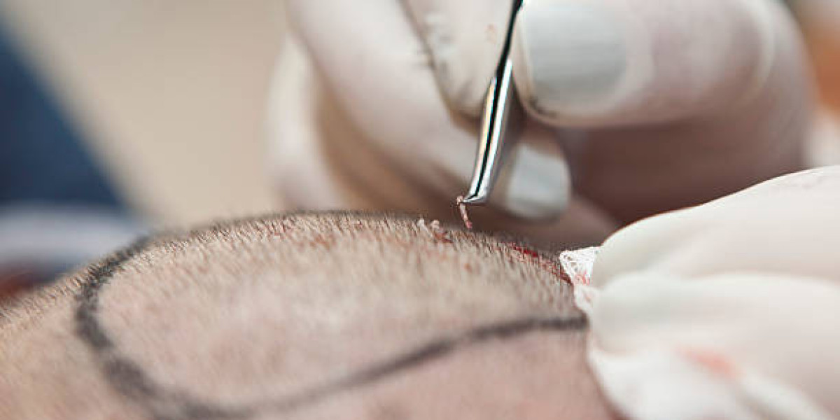 Hair Transplant for Women: Tailored Solutions for Female Pattern Baldness