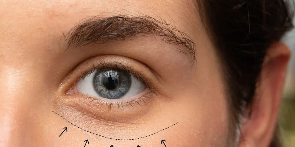 Discover Advanced Techniques in Eyelid Surgery at Royal Clinic Saudia