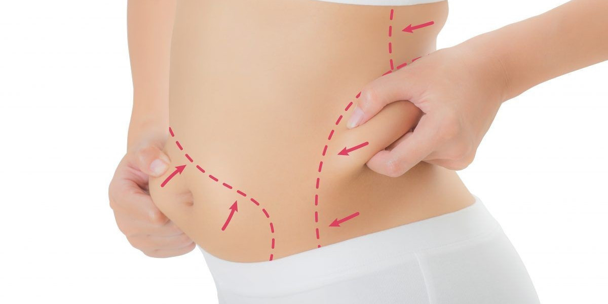 Post-Liposuction Care Tips for Faster Healing and Comfort