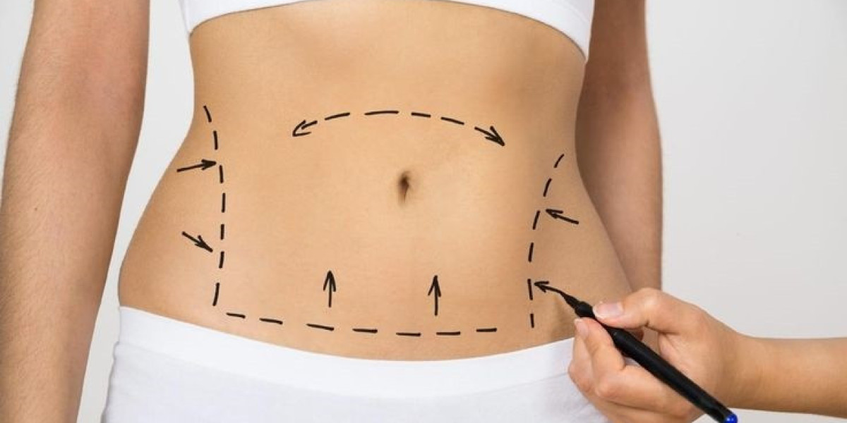 Liposuction and Body Confidence Improvement Insights