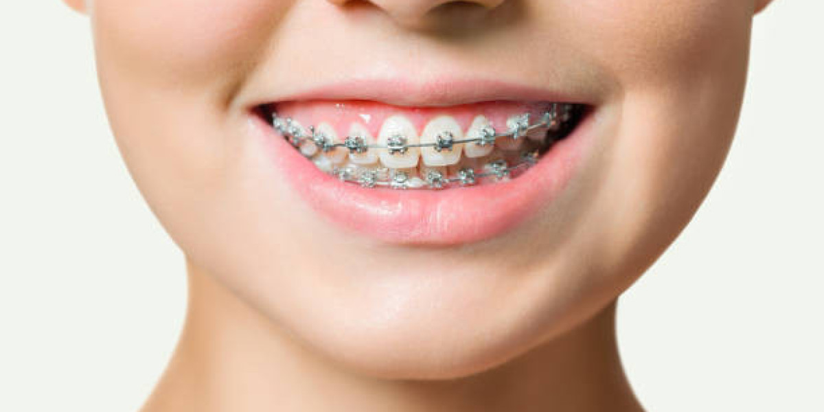 Teeth Braces Wires Explained: Powers Behind Progressive Tooth Movement