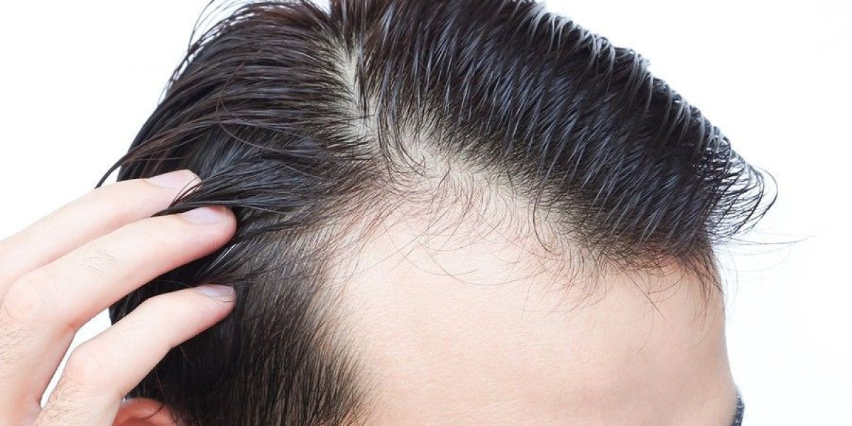 Affordable Yet Premium Hair Loss Treatment at Royal Clinic Saudia