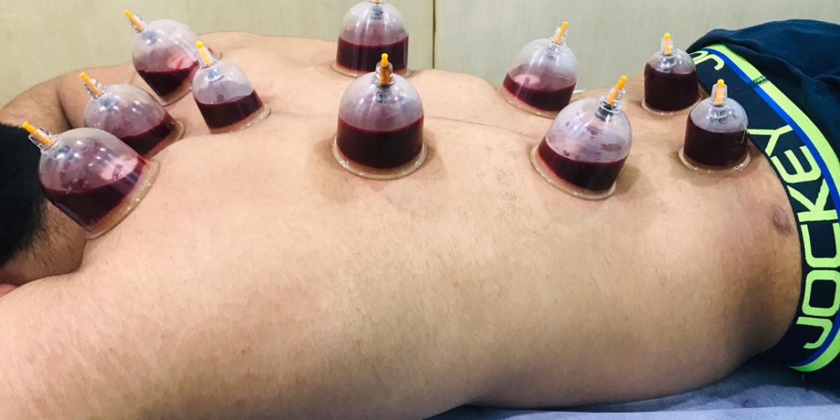 Detox and Revitalize Naturally Using Hijama Cupping Therapy Methods