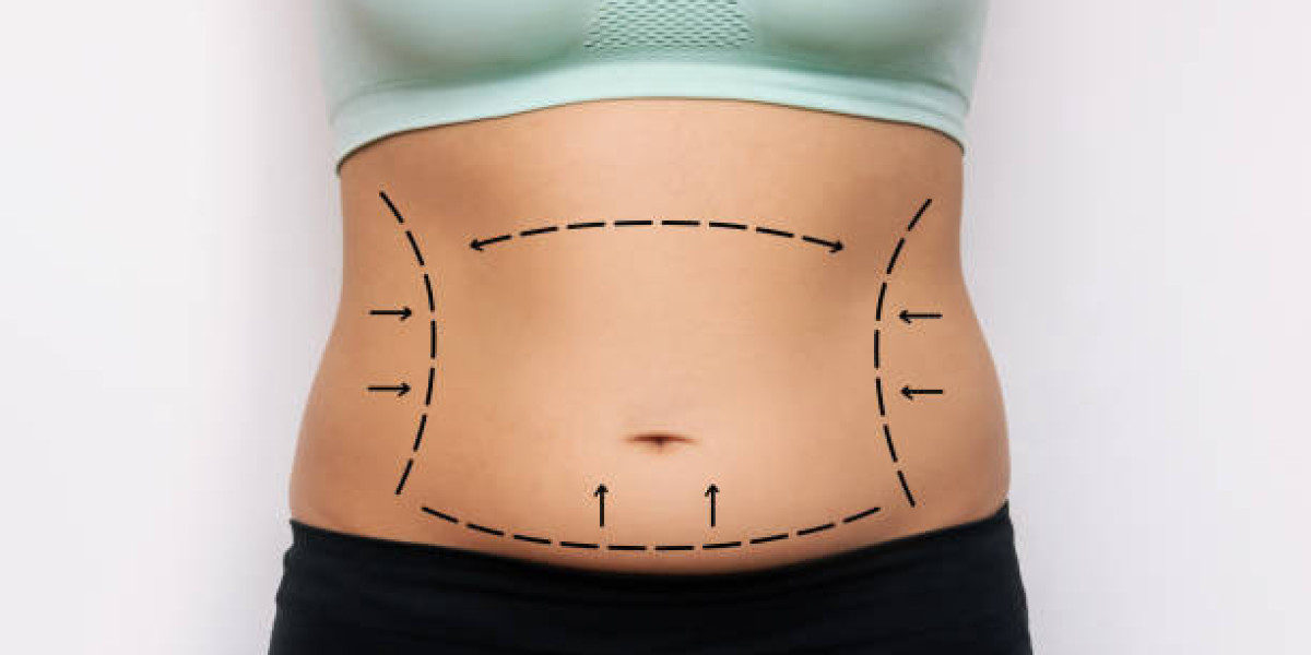How Soon Back to Work After BodyTite Liposuction?