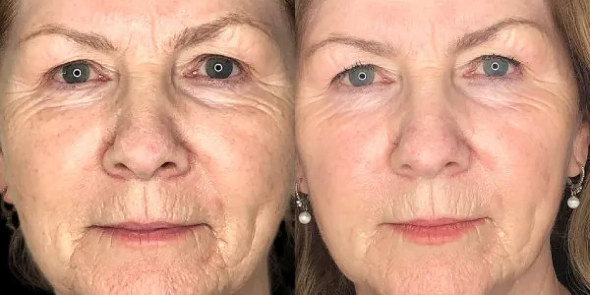 Best Plastic Surgeon in Dubai Offering Elite Profhilo Treatments