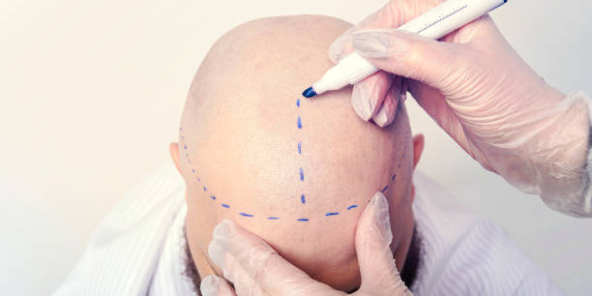 Hair Transplant Consultation Guide: Ask These Key Questions
