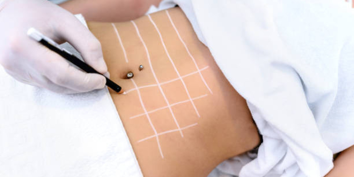 Optimizing Fat Melting Injections with Sleep and Stress Tips