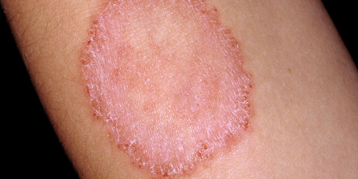 Itraconazole for Ringworm