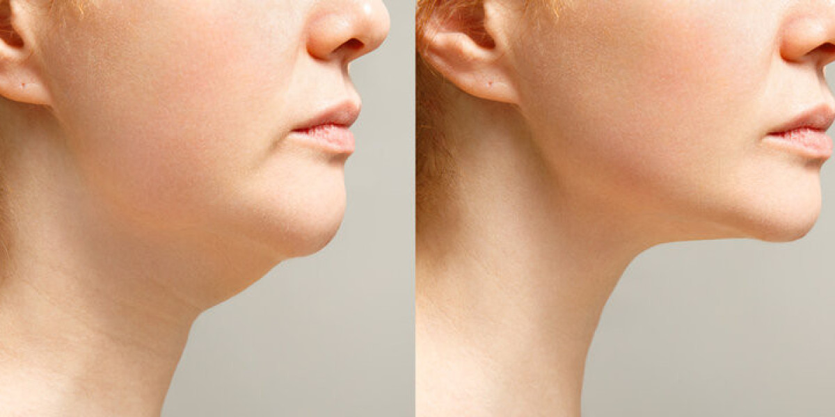 Expert Tips for a Successful Double Chin Liposuction