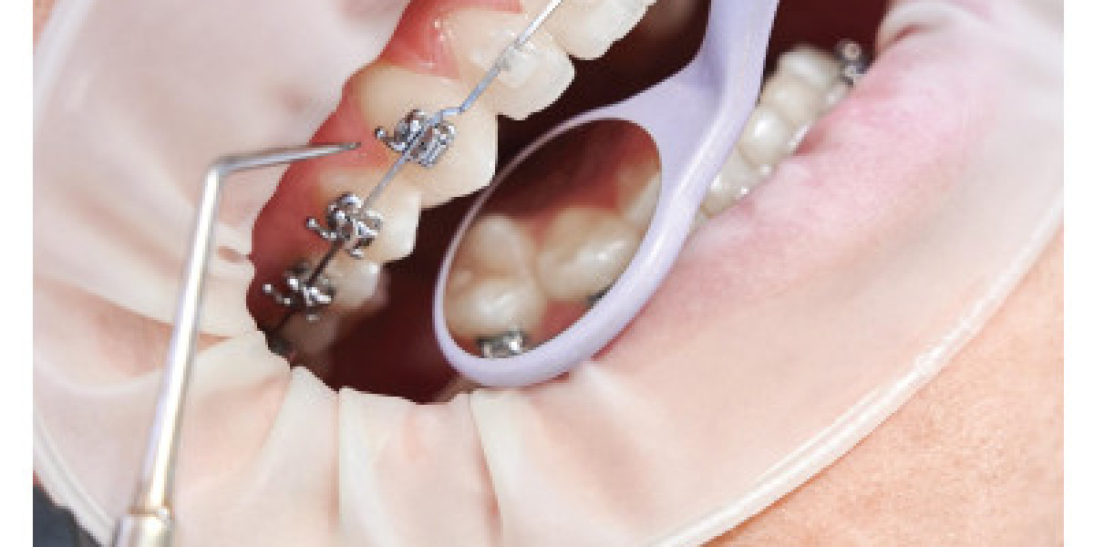 Dental Braces in Islamabad: Achieve Your Perfect Smile at Enfield Royal Clinic