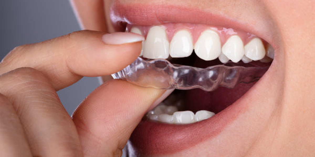 Teeth Aligners – Tailored for Your Perfect Smile