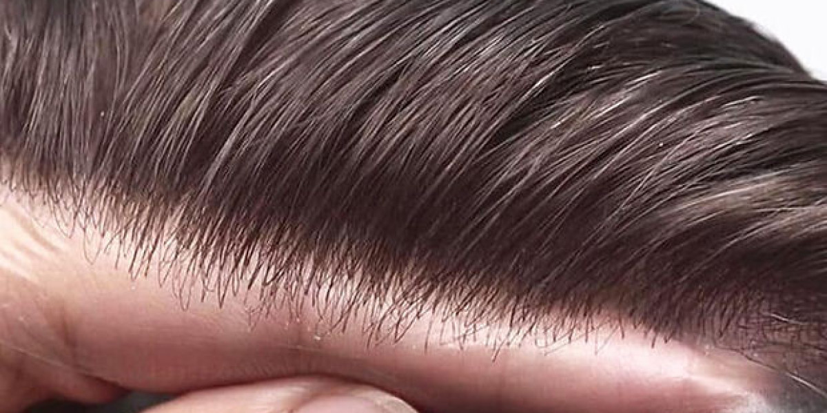 Discover Hair Replacement Solutions That Revive Confidence