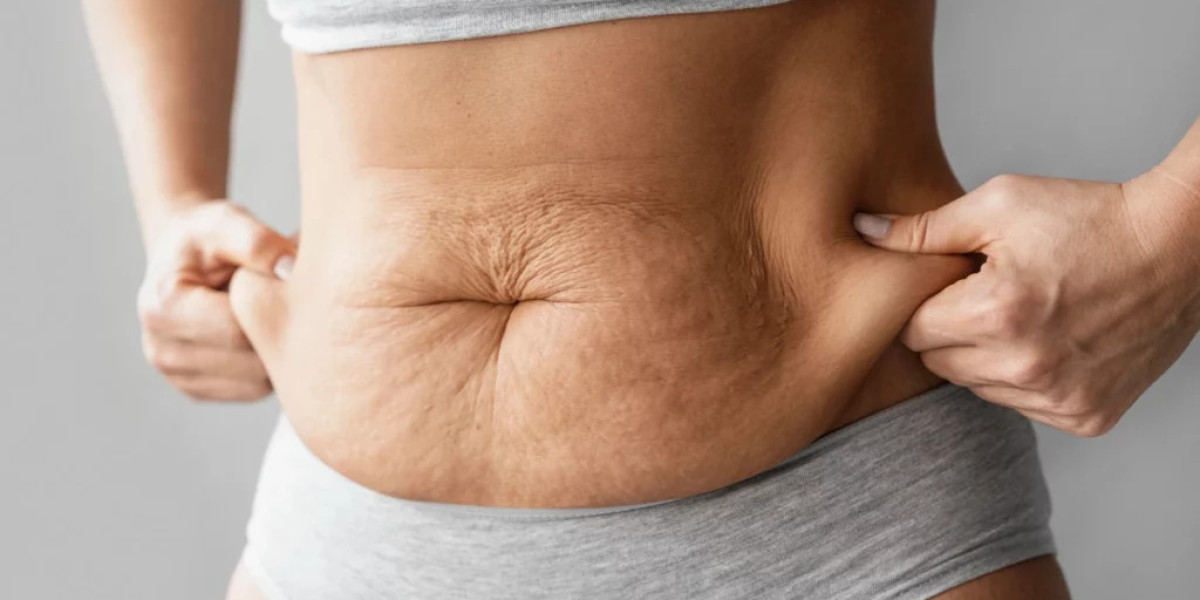 Tummy Tuck Surgery: A Step-by-Step Procedure Explained