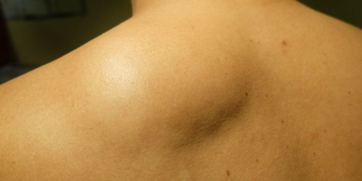 Trusted Lipoma Removal in Islamabad – Smooth & Confident