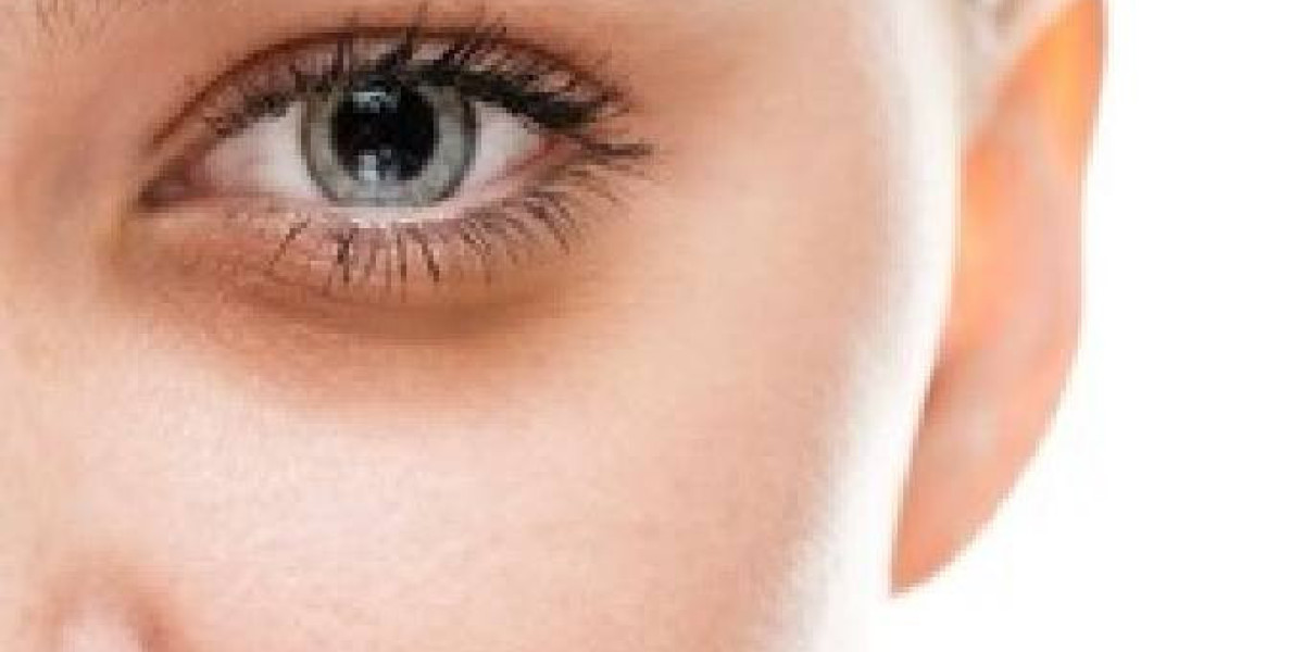 Restore Confidence with Dark Circles Treatment in Islamabad